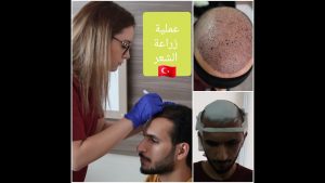 اماكن بيع الشعر الطبيعي في تركيا